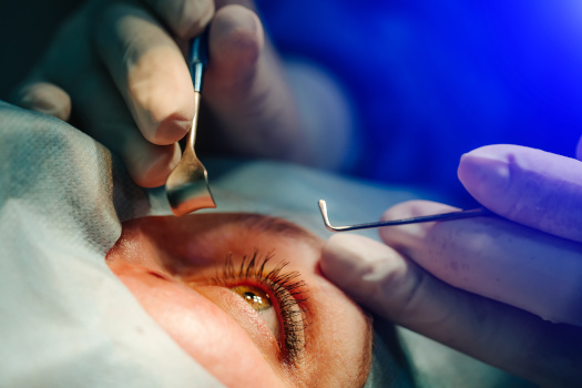 Does Having Cataract Surgery Affect Car Insurance in San Diego, CA
